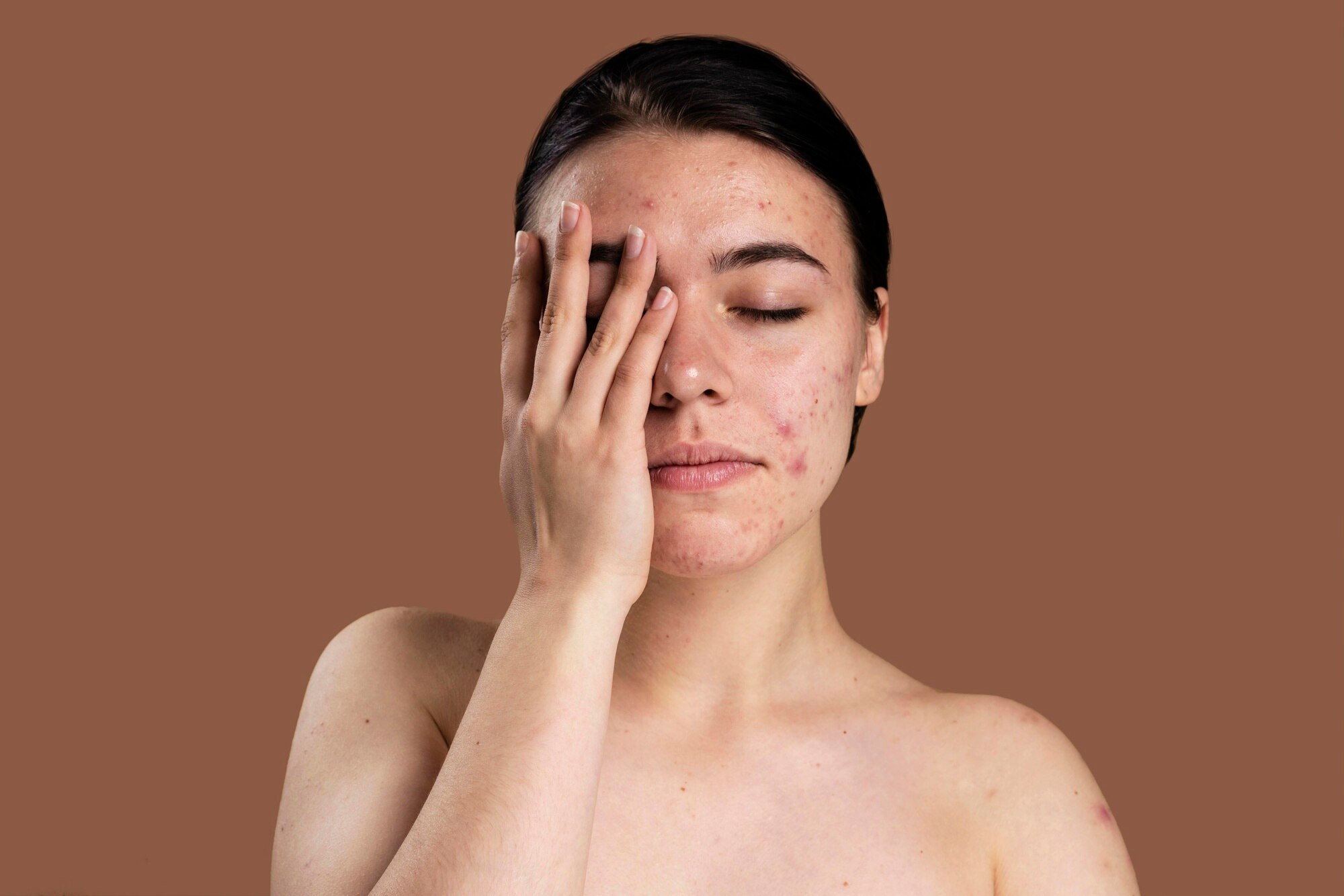 acne problems that are curable through red light therapy